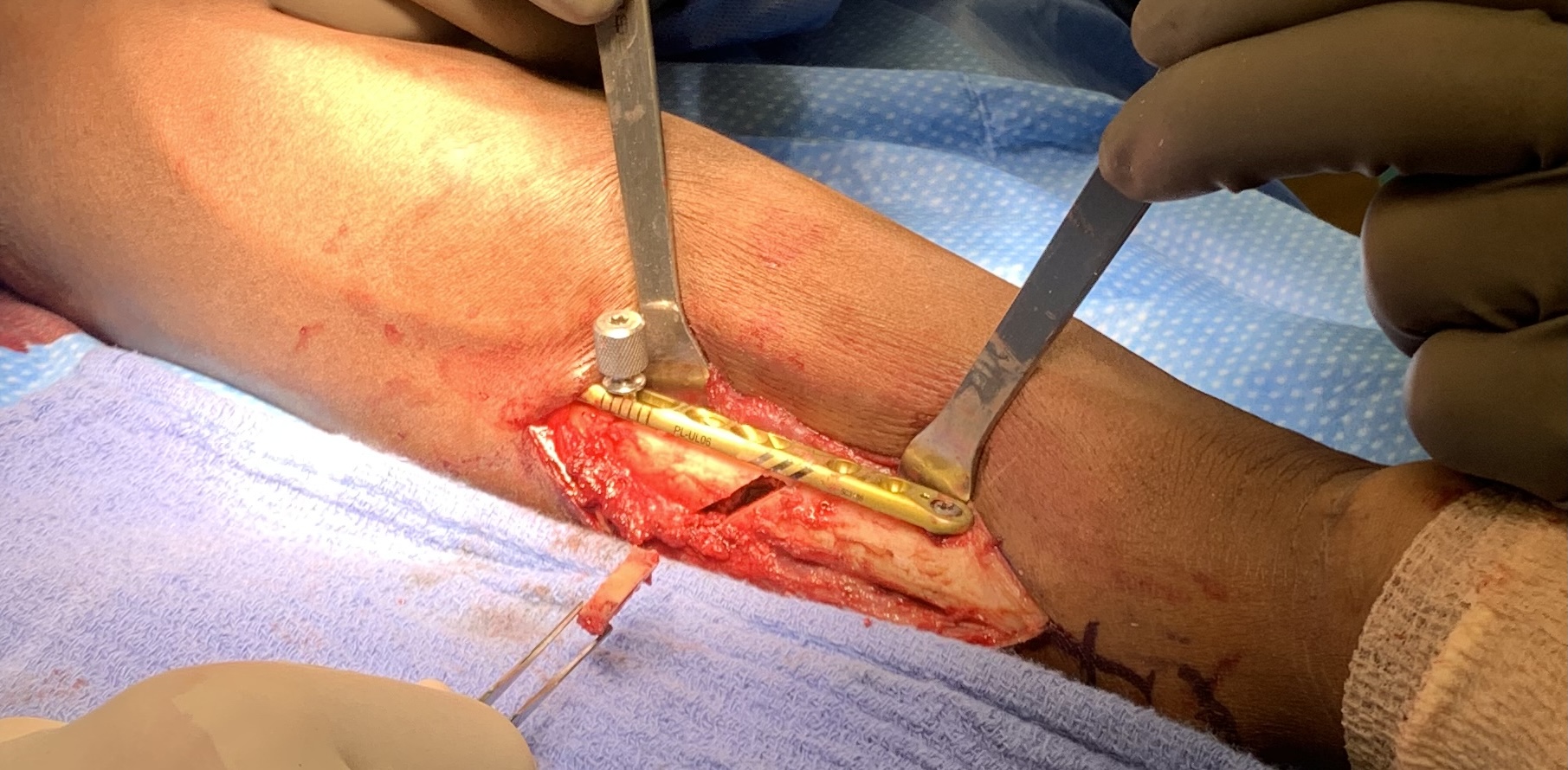 Ulnar Impaction Syndrome (UIS) What is Ulnar Impaction Syndrome?