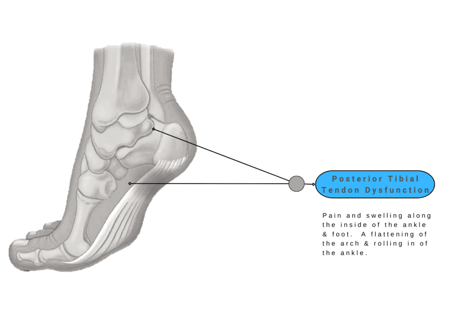 Insoles for Posterior Tibial Tendon Dysfunction Archives Orthotic