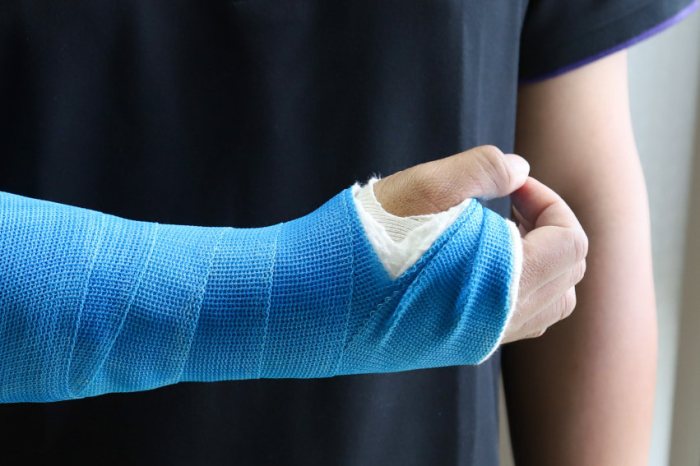 Air Cast For Fracture Wrist Cast in mash