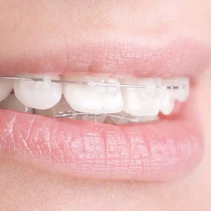 BRACKET ESTÉTICO "CRYSTAL CLEAR ZAFIRO" ROTH .022 Ortoarea