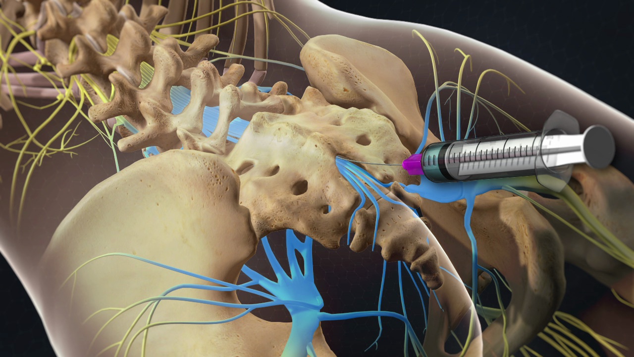 Caudal Epidural Steroid Injection Video Orthopedic Doctor in Vero Beach, Florida