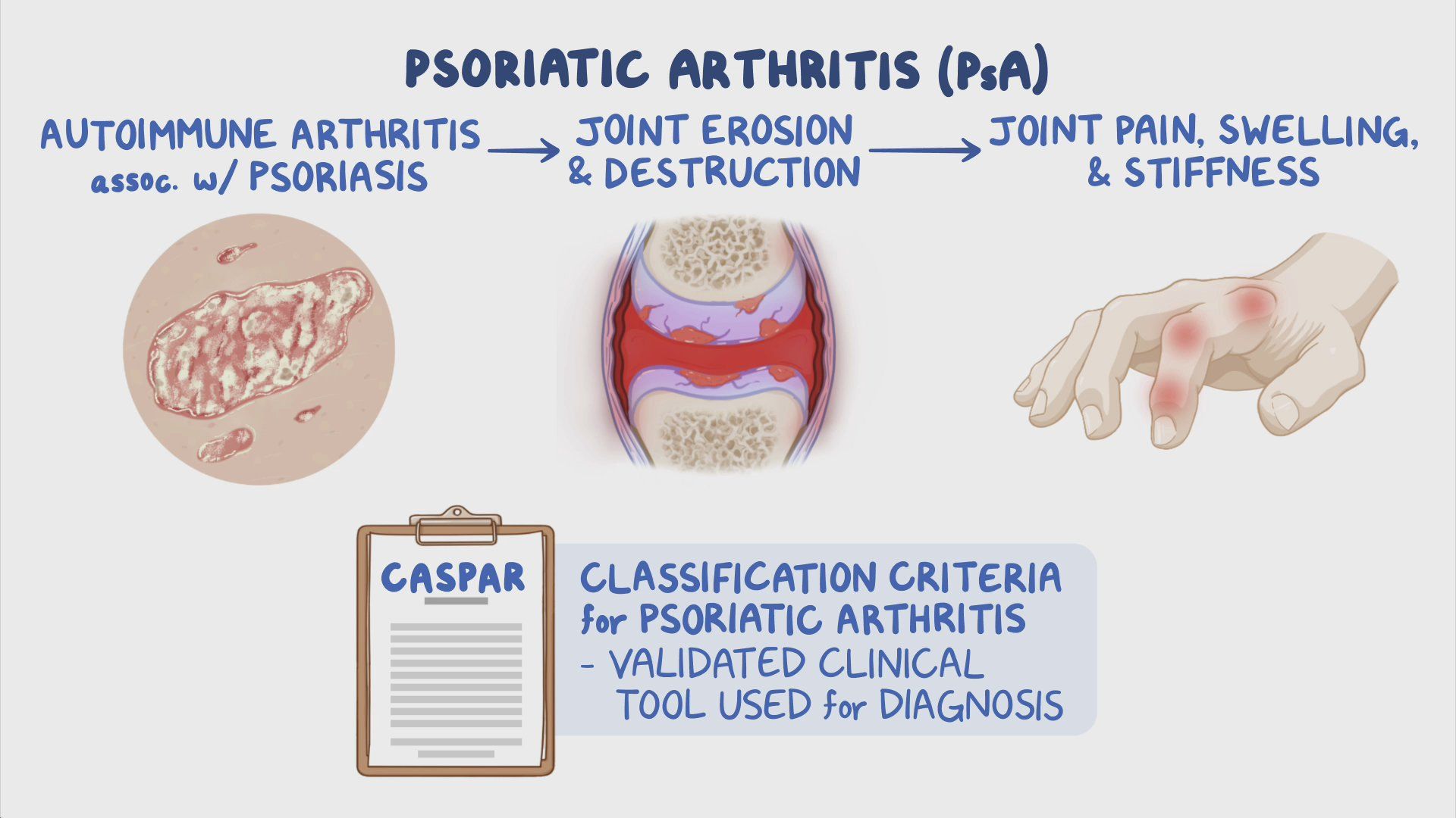 Psoriatic arthritis Clinical sciences Osmosis Video Library