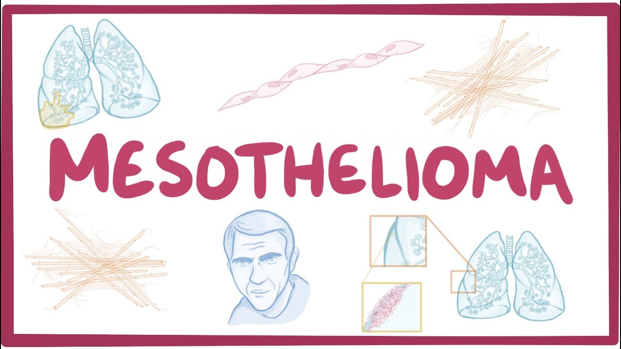 Mesothelioma Video, Causes, & Meaning Osmosis(04)
