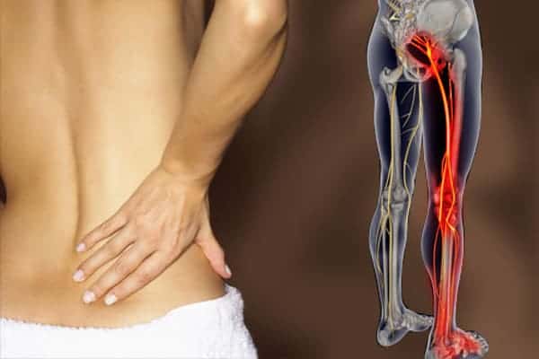Sciatica: Osteopathic Natural Health