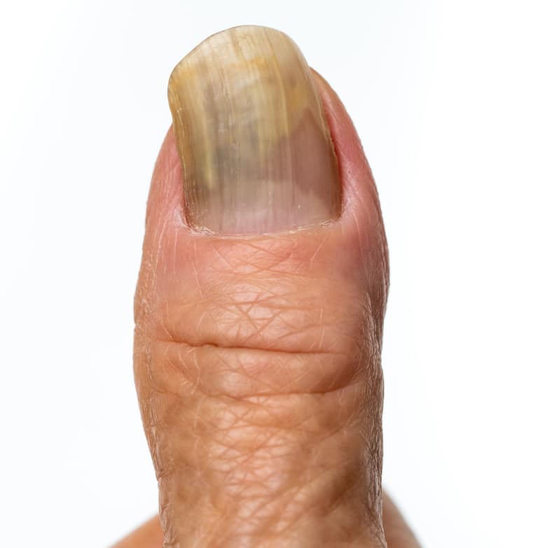 Fingernagelpilz behandeln Übersicht der Mittel (2021)