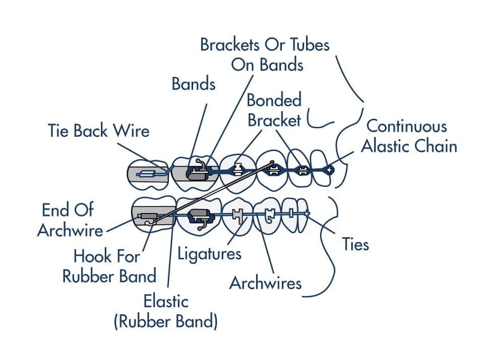 Braces Diagram Othman Orthodontics