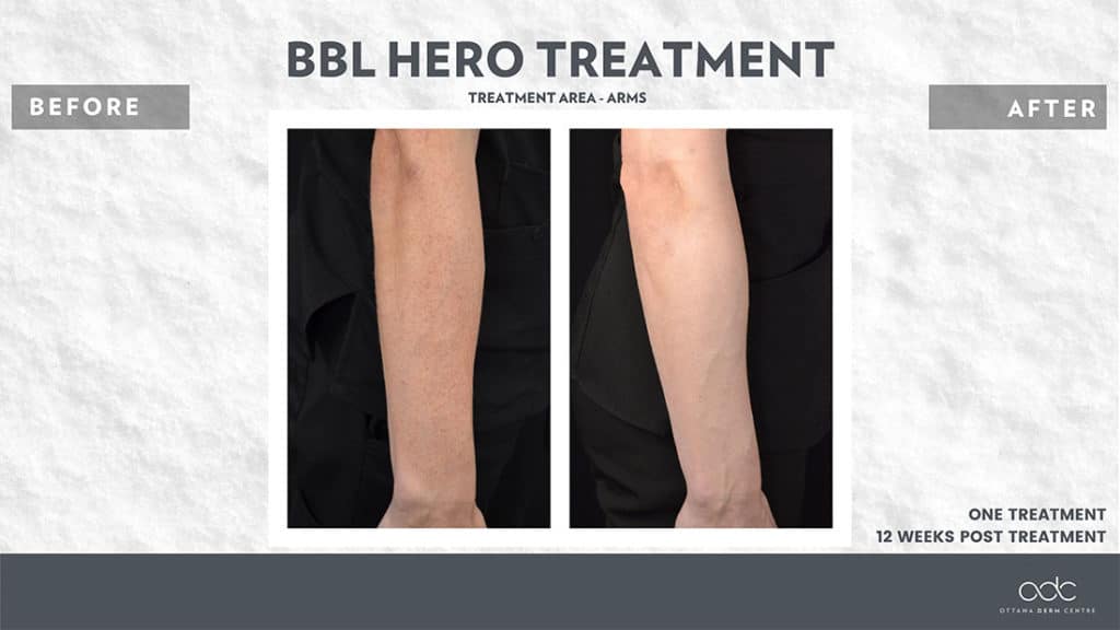 Laser Skin Rejuvenation Ottawa ON Laser Skin Resurfacing