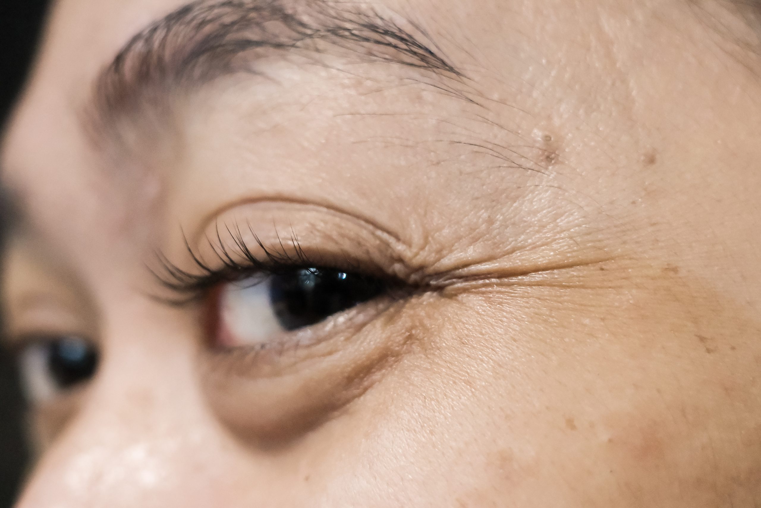 Demystifying Eye Bags Causes, Types, and Treatment