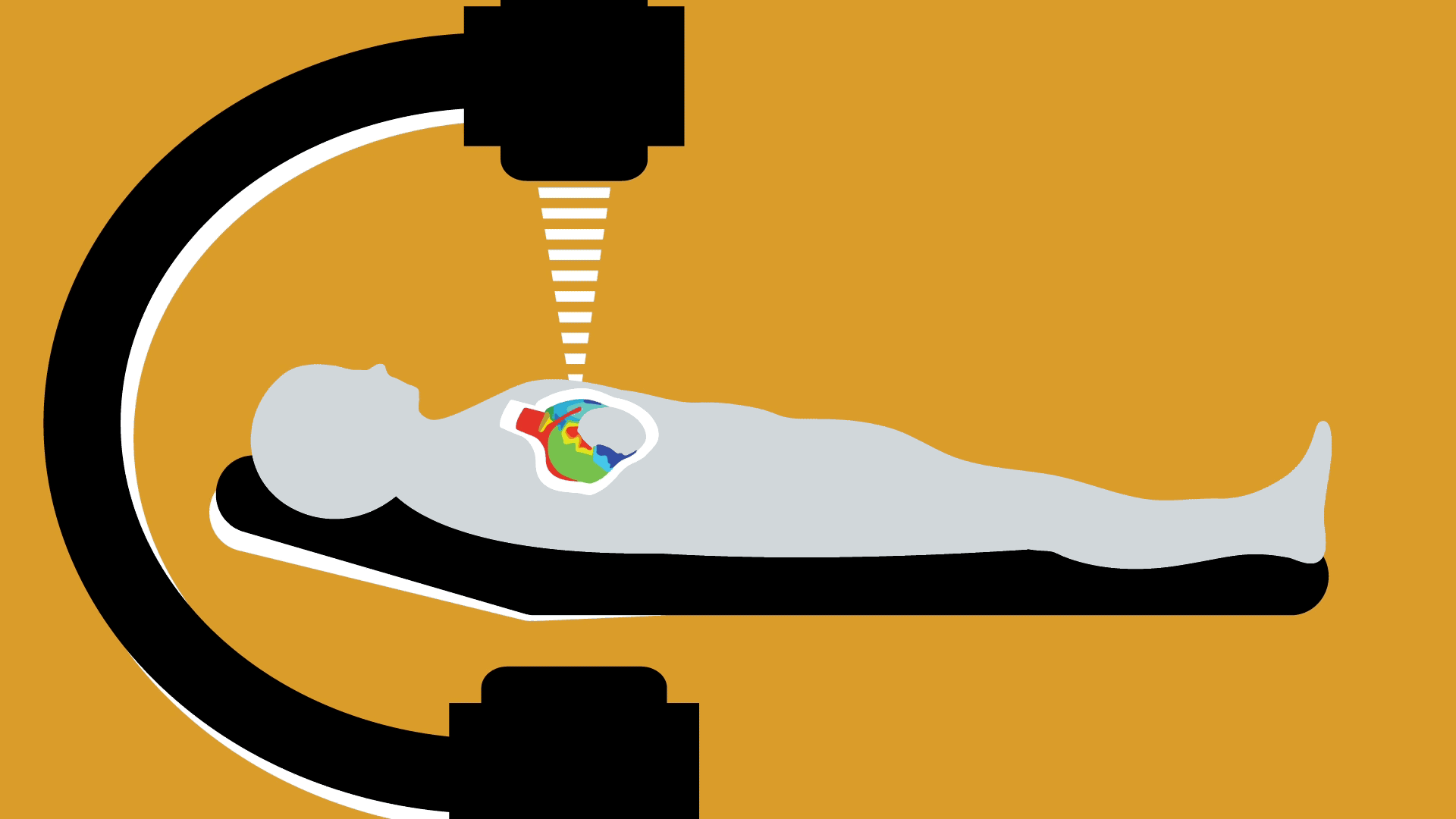 Radiation beam to the heart Outlook Magazine