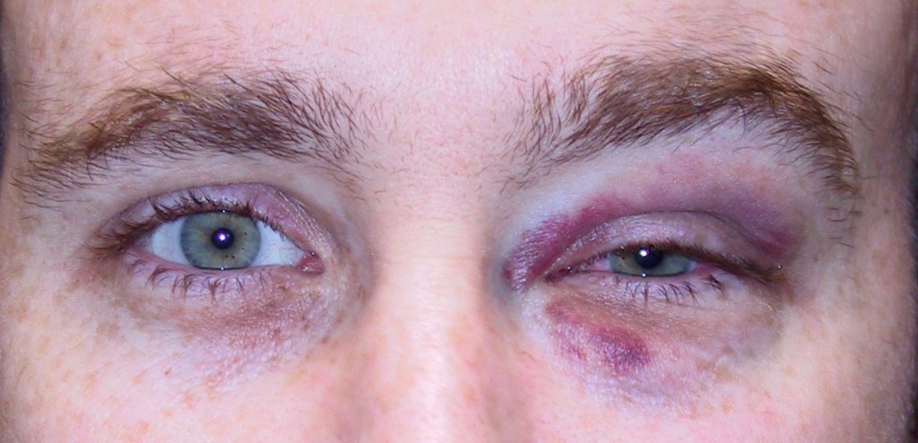 Een Blauw Oog - Alles Over Het Menselijk Oog