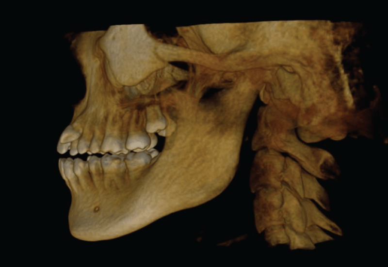 Cone Beam 3D XRays Dental Beam X Ray Fair Oaks CA Ovsmile