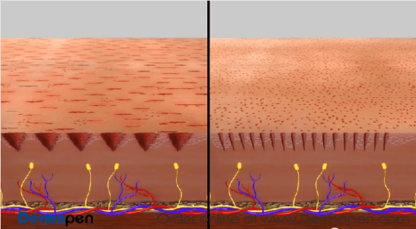 Dermapen can cause skin microtearing but the Derminator® won't