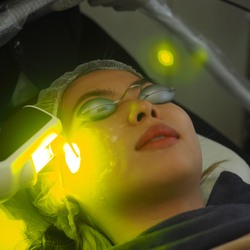 Pro Yellow Laser Skin Treatment in Singapore Ozhean Zoey Korean