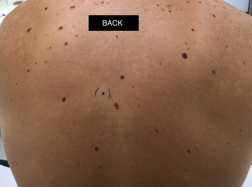 WHO IS WATCHING YOUR BACK? Oz Skin Cancer Clinic Pakenham Melbourne