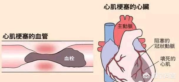 心肌梗死发生后还能活多久呢？生活百科