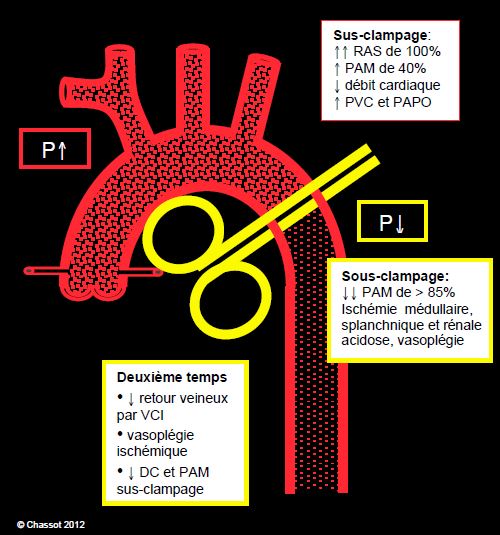 Précis d’Anesthésie Cardiaque 6 18.4.2 Physiopathologie du clampage