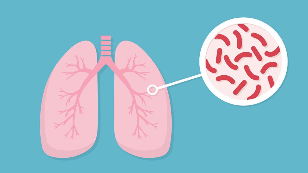 Tuberculosis Symptoms and causes Pacific Cross Vietnam