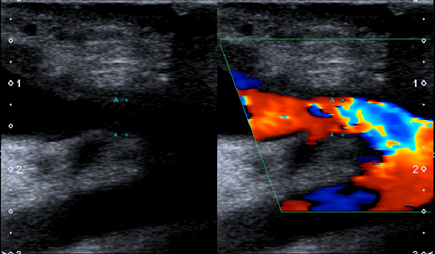 Dialysis Vascular Access Site Ultrasound Exam & Clinical Indications