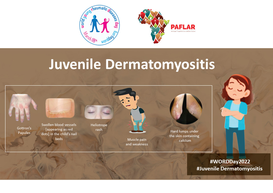 Juvenile Dermatomyositis PAFLAR