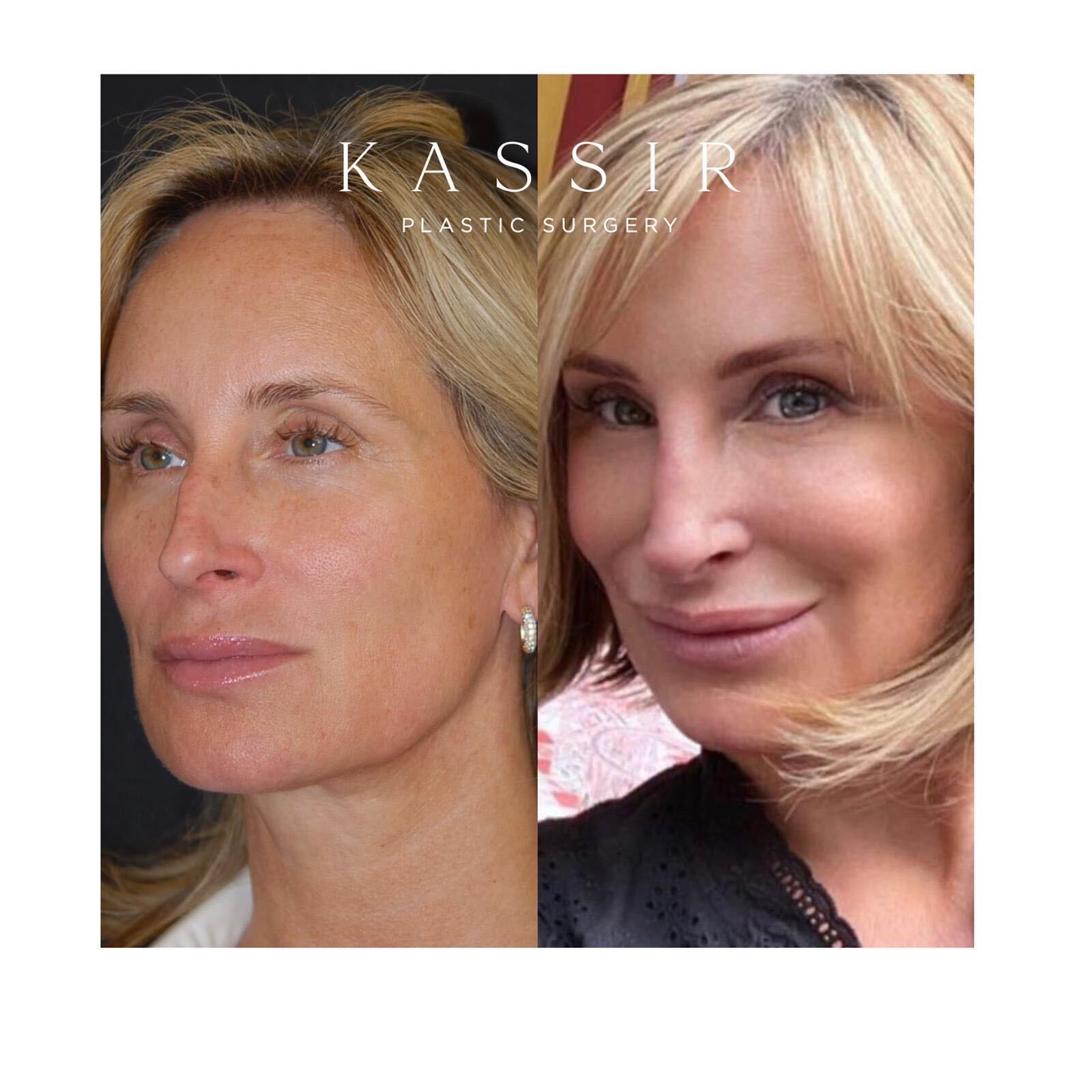 Sonja plastic surgeon Dr. Kassir reveals details