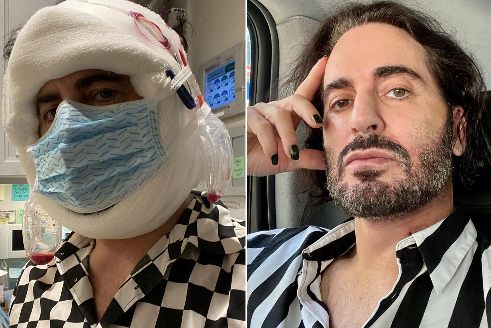 Marc Jacobs on plastic surgery 'No shame in being vain'