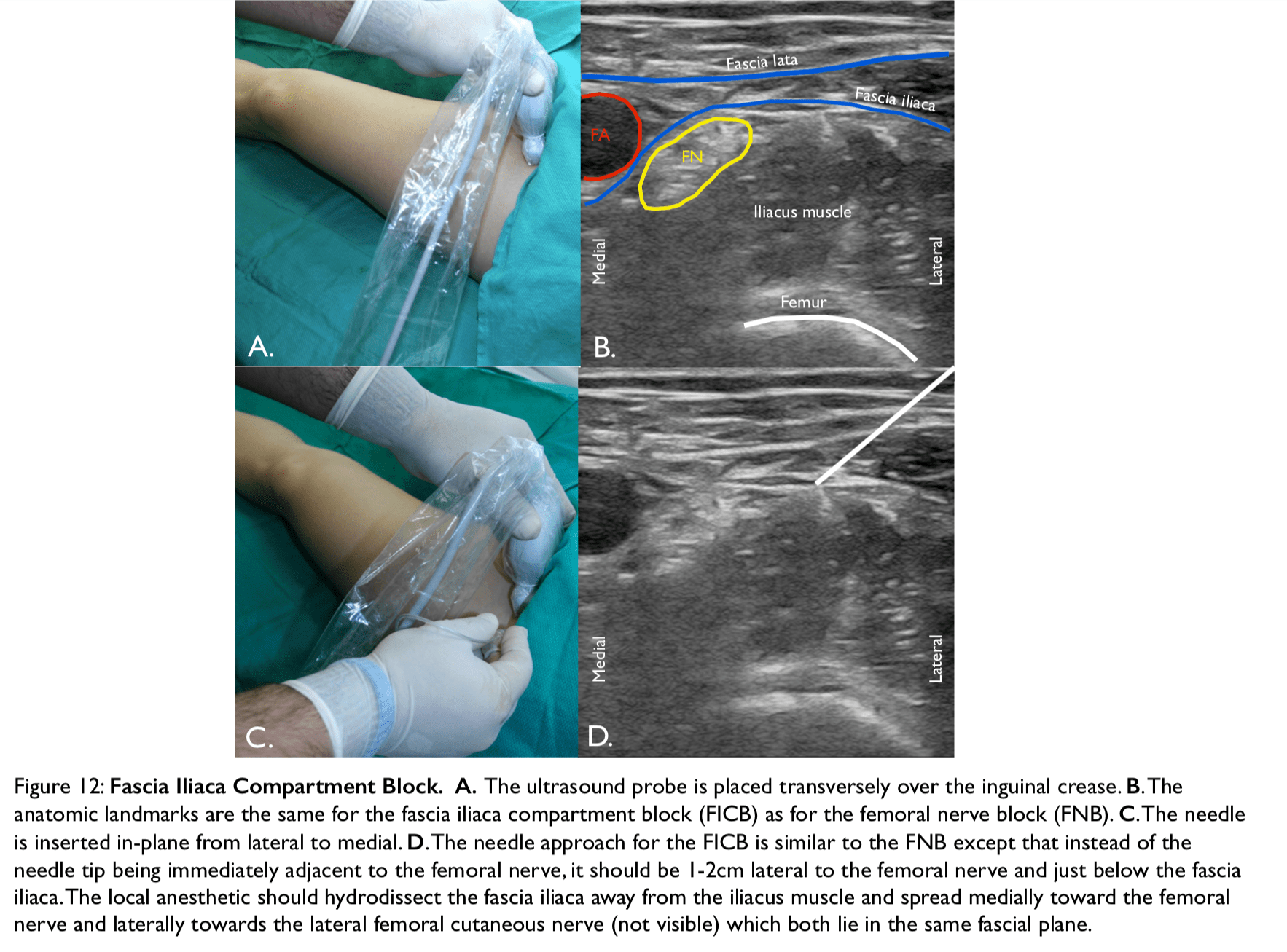 UltrasoundGuided Regional Nerve Blocks in Emergency Medicine