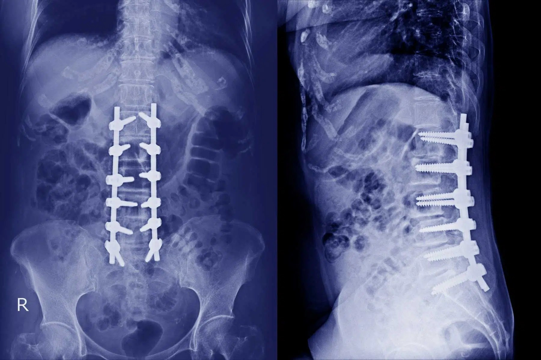 What Is Degenerative Disc Disease Lumbar at Joanna Prescott blog