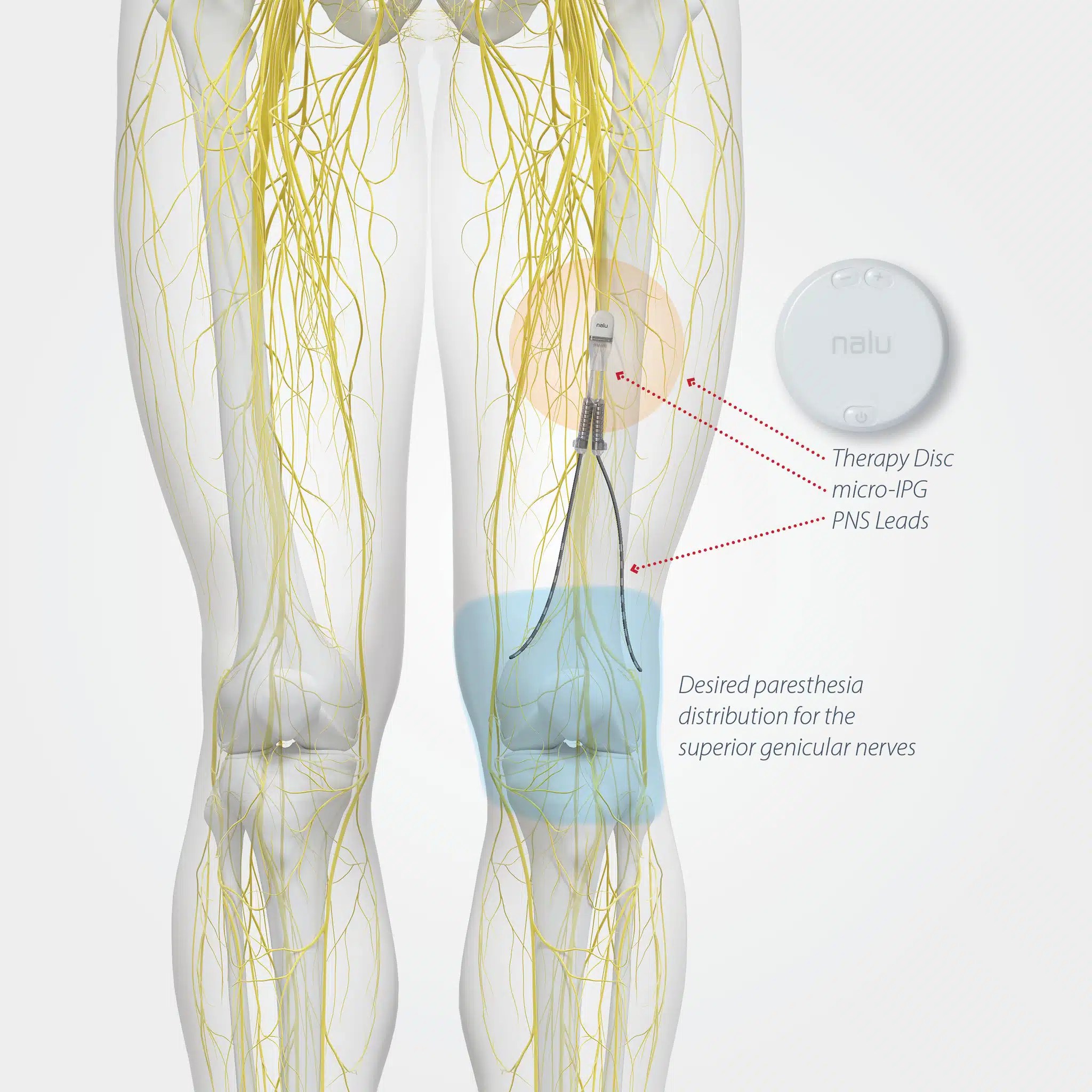 Peripheral Nerve Stimulation Pain and Spine Specialists