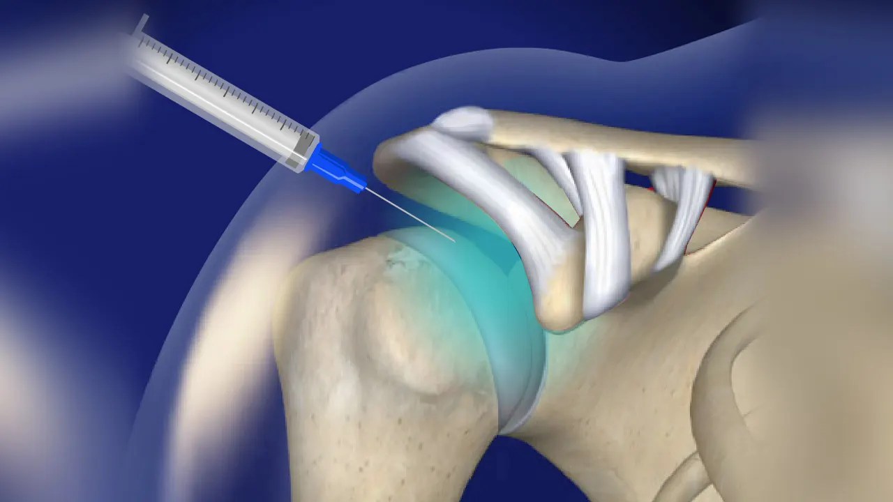 Joint Pain Injections Houston & Victoria TX Pain & Spine TX