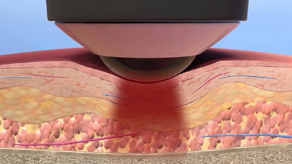 Laser Therapy Pain Free New Mexico