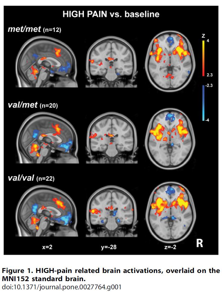 COMT Pain Genes Wreak Havok Finally a Good Study Pain Medical Musing