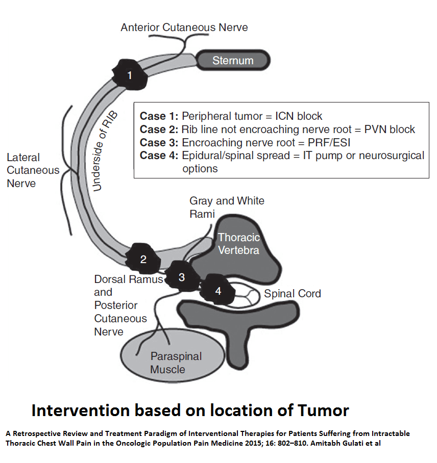 Chest Wall Cancer Treatments Pain Medical Musing