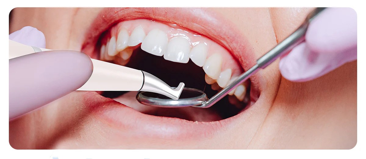 Can Air Polishing Whiten Your Teeth?