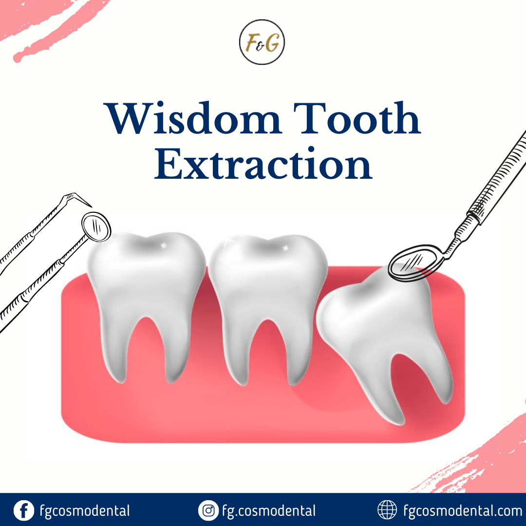 Wisdom Tooth Extraction (1) Pakistan Places