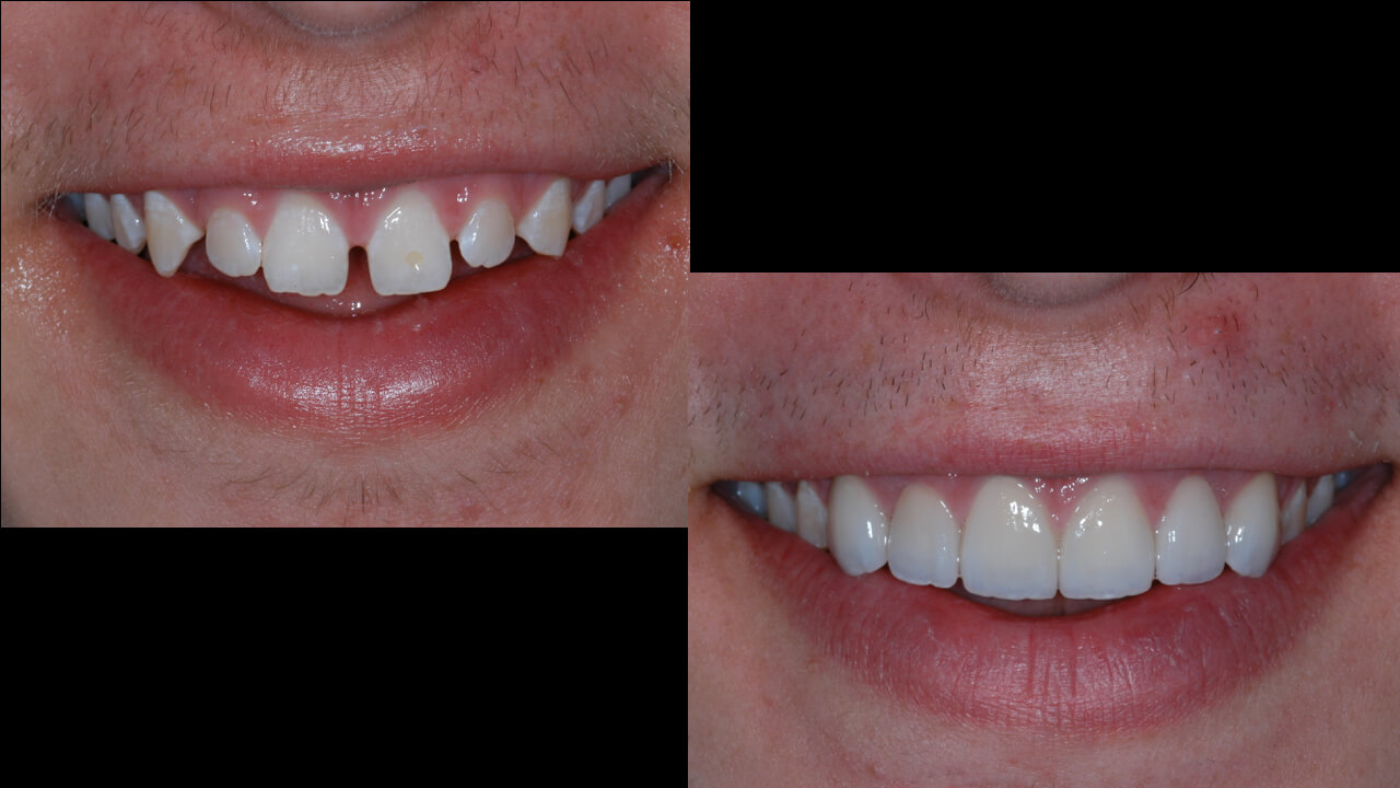 Case Report Ceramic Veneers & Invisalign Part One PankeyGram