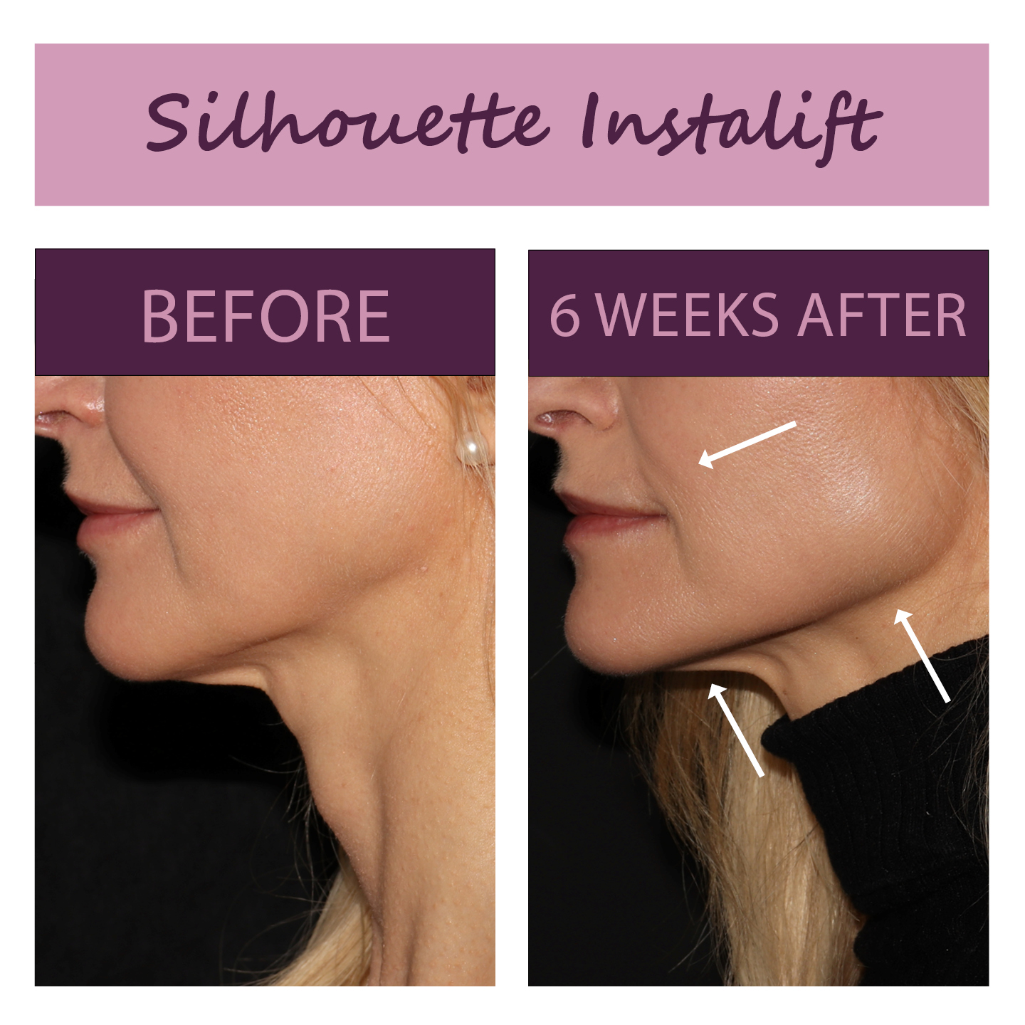 Facelift Calgary Papillon Medical Aesthetics