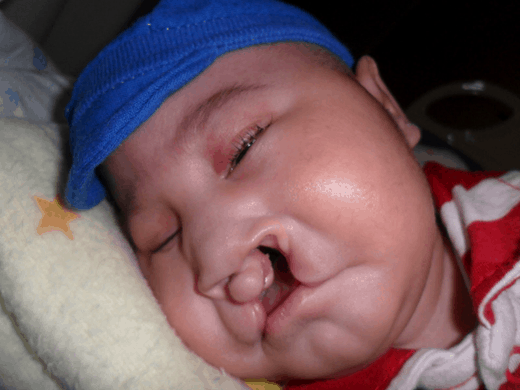 El Síndrome de Patau CURSO DE PEDIATRÍA Paradigmia