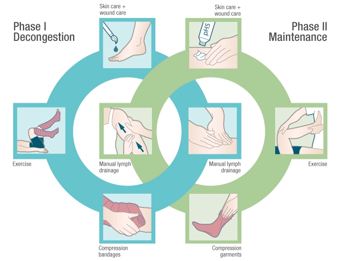 Lymphedema Treatment & Plan of Care Paradigm Physical Therapy