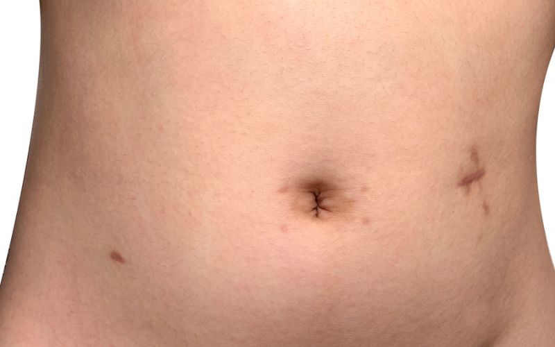 Belly Button Yeast Infection How To Get Rid Of It?