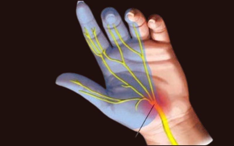 Chronic Paresthesia Causes, Symptoms and Treatment