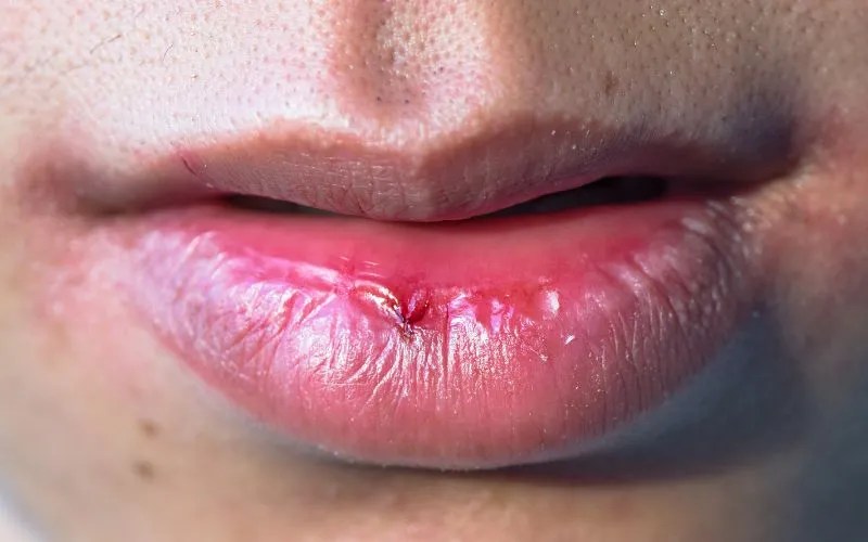 Lips Exfoliation Best ways to get rid of dead skin cells on lips