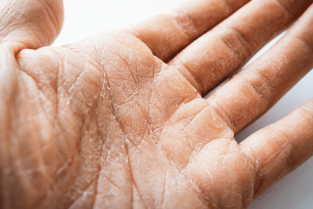 Causes and Treatments for Skin Peeling from Palms