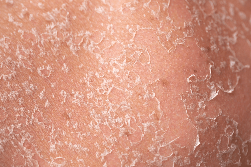 Causes and Treatments for Skin Peeling from Palms
