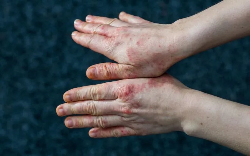 Dyshidrotic Eczema Causes, Symptoms, and Treatment