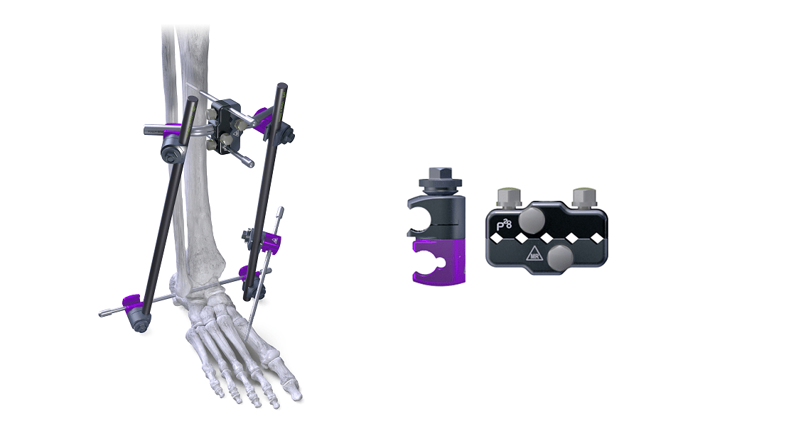 Monkey Bars™ Pin to Bar External Fixation System Paragon 28