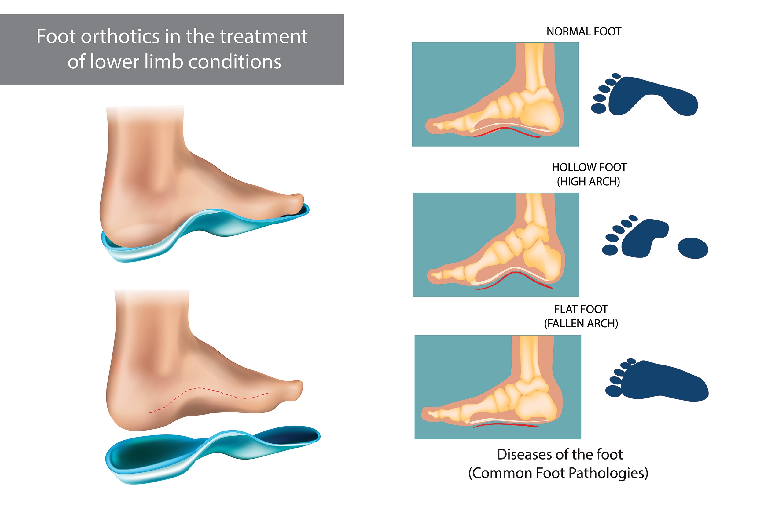 Orthotics Parallel Chiropractic & Wellness Centre