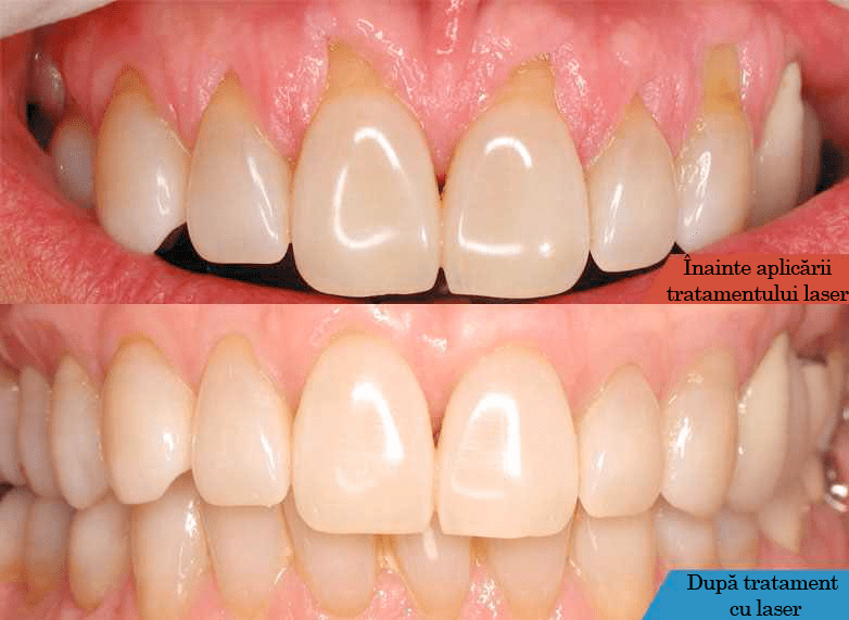 Parodontoză? Te ajutăm! ULTRADENT