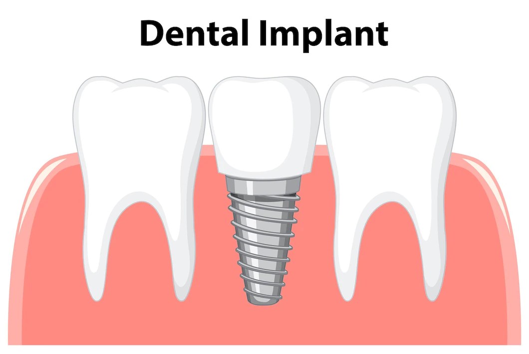 Tooth Implants Are Modern Innovation Best Dental Clinic