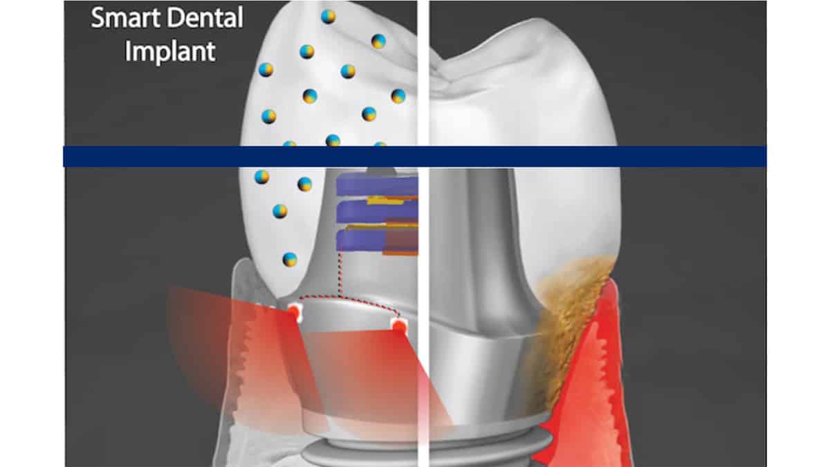Smart Dental Implants Can Address a Diverse Set of Tooth Health Issues