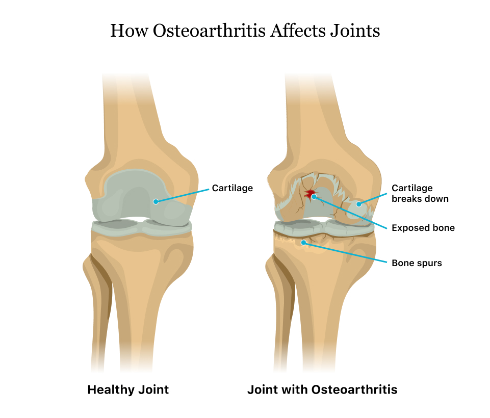 Perbedaan Osteoarthritis dan Rheumatoid Arthritis » Klinik Patella